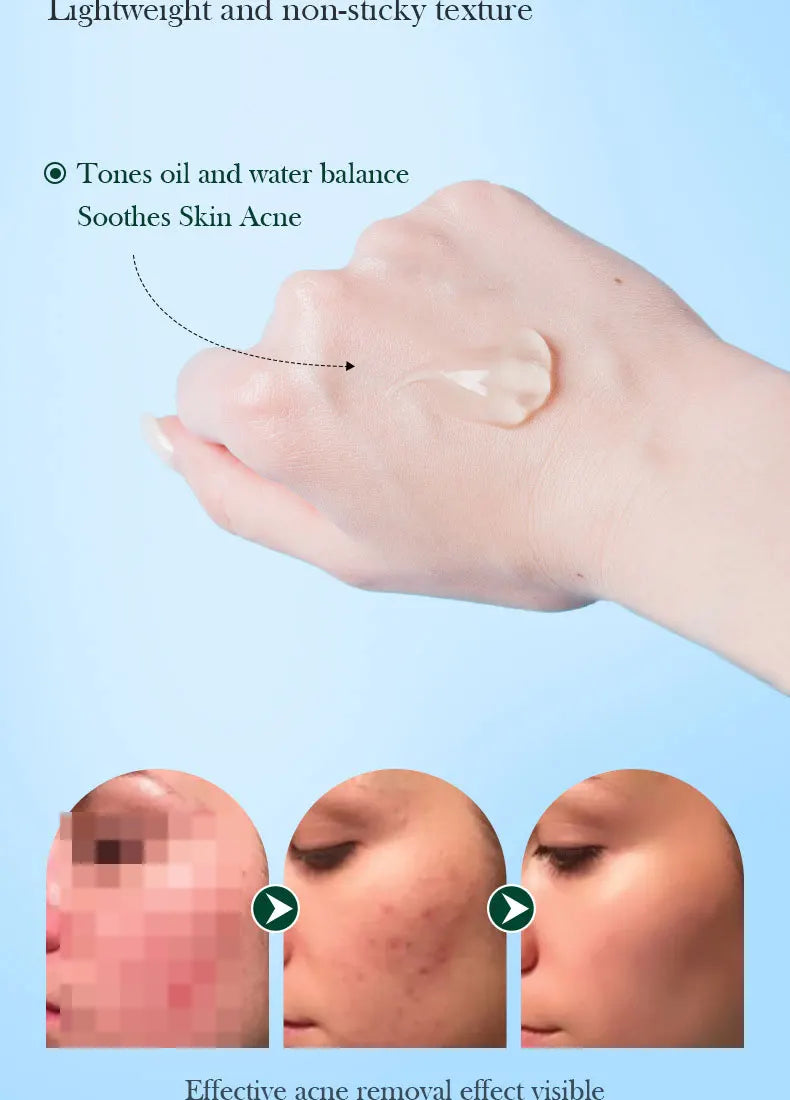 SADOER Tea Tree Acne Removing Cream Facial Skincare Oil Control Face Gel Creams Hydrating Moisturizing Facial Cream Skin Care