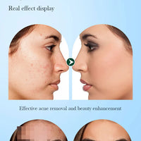 SADOER Tea Tree Acne Removing Cream Facial Skincare Oil Control Face Gel Creams Hydrating Moisturizing Facial Cream Skin Care