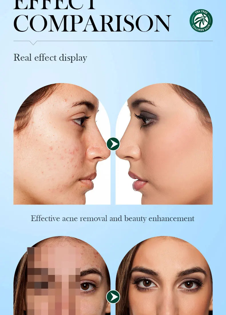 SADOER Tea Tree Acne Removing Cream Facial Skincare Oil Control Face Gel Creams Hydrating Moisturizing Facial Cream Skin Care